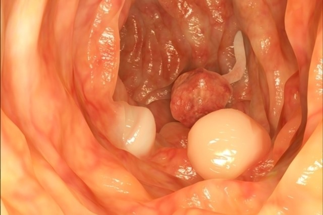                 Figura 2. Pólipos adenomatosos em mucosa intestinal